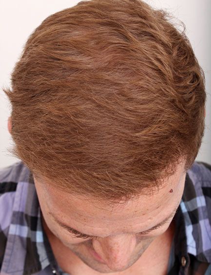 After hair restoration