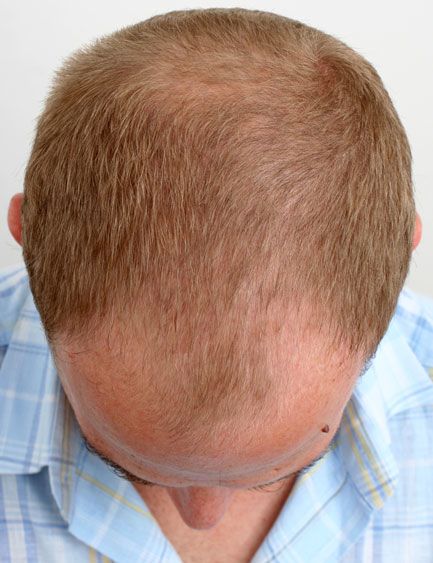 Before hair restoration