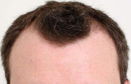 before hair restoration