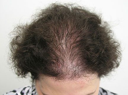 before hair restoration