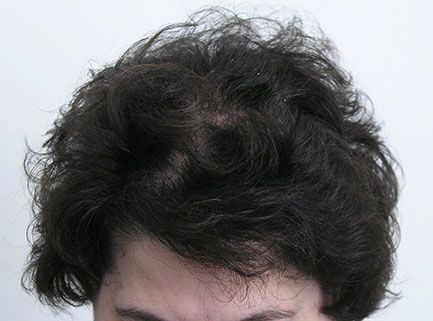 after hair restoration