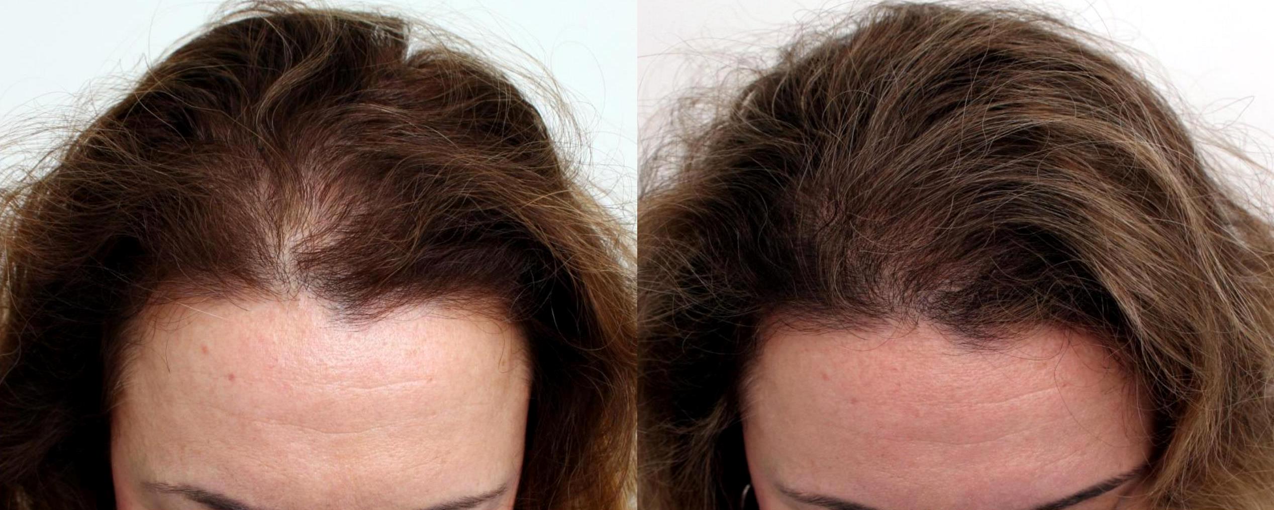 Women Before After FUT Hair Transplant