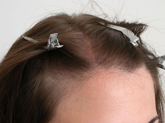 before FUT hair transplant