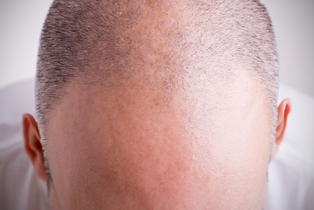 Balding man's scalp with short hair