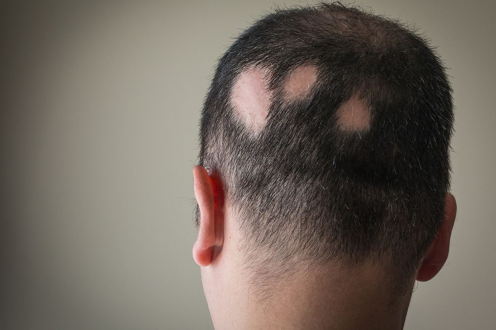 Back of man's head with large bald spots